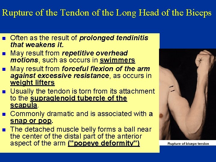 Rupture of the Tendon of the Long Head of the Biceps n n n