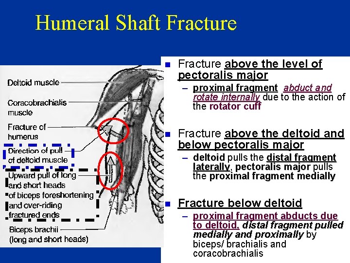 Humeral Shaft Fracture n Fracture above the level of pectoralis major – proximal fragment