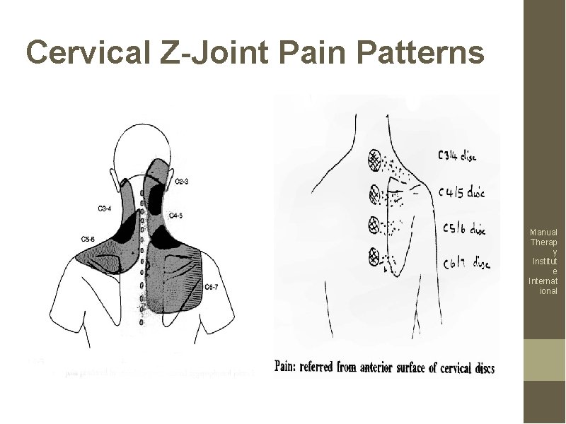 Cervical Z-Joint Pain Patterns Manual Therap y Institut e Internat ional 