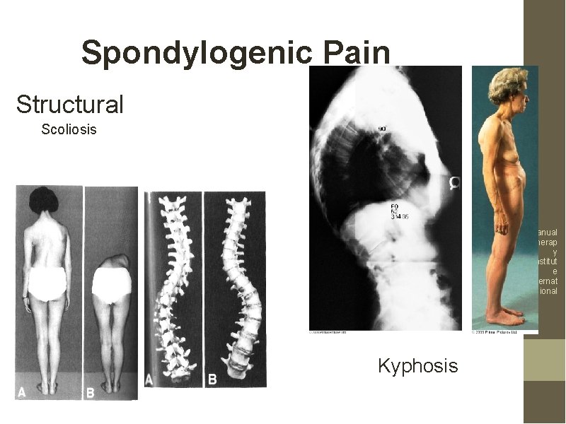 Spondylogenic Pain Structural Scoliosis Manual Therap y Institut e Internat ional Kyphosis 