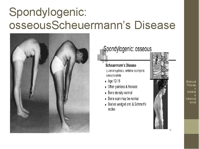 Spondylogenic: osseous. Scheuermann’s Disease Manual Therap y Institut e Internat ional 