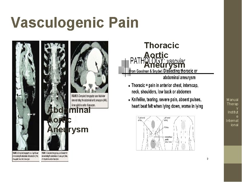 Vasculogenic Pain Thoracic Aortic Aneurysm Abdominal Aortic Aneurysm Manual Therap y Institut e Internat