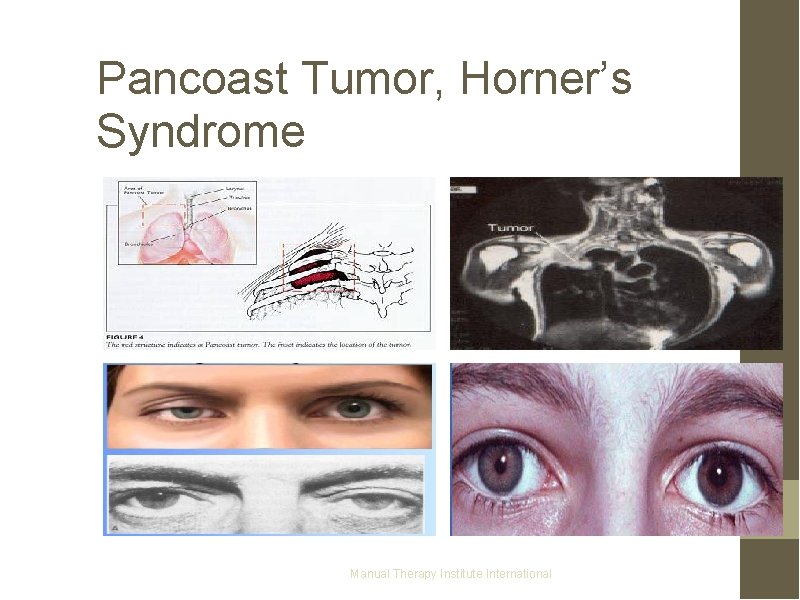 Pancoast Tumor, Horner’s Syndrome Manual Therapy Institute International 