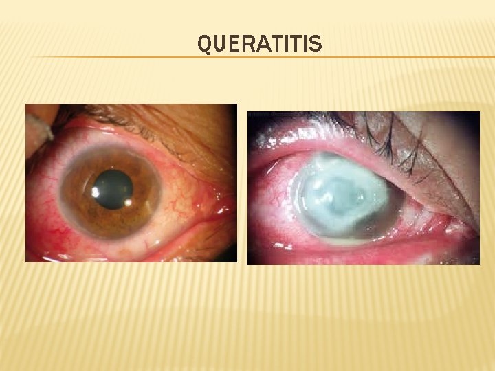 QUERATITIS 