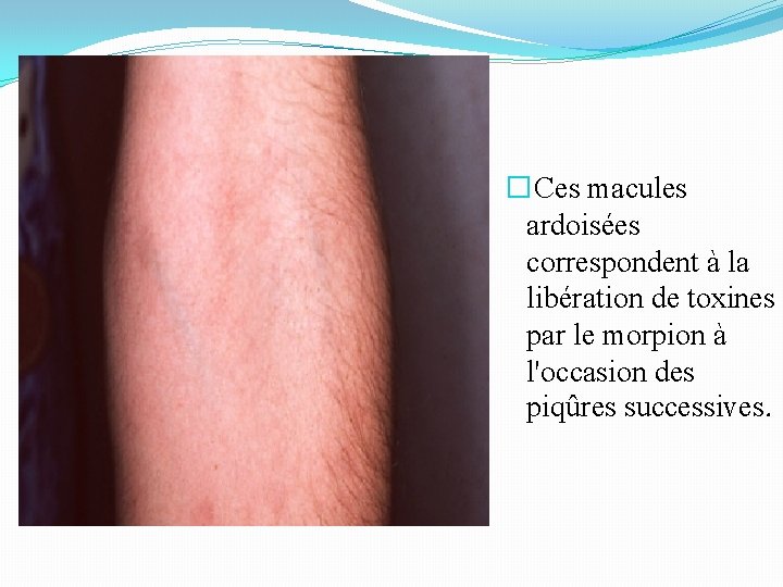 � Ces macules ardoisées correspondent à la libération de toxines par le morpion à