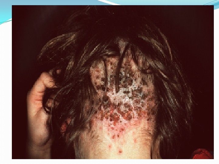 Pédiculose du cuir chevelu Pédiculose du cuir chevelu