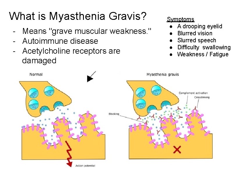 What is Myasthenia Gravis? - Means "grave muscular weakness. " - Autoimmune disease -