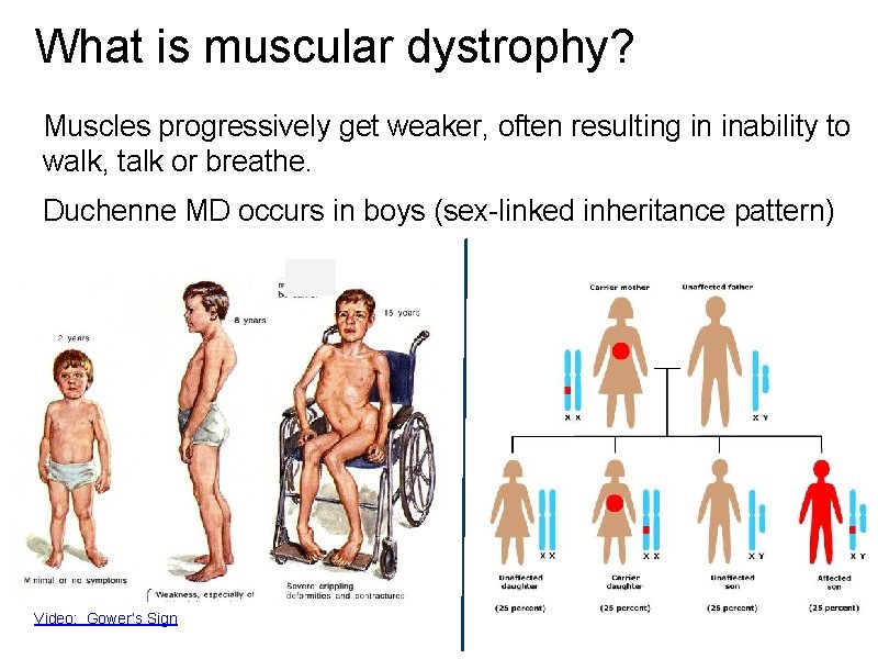 What is muscular dystrophy? Muscles progressively get weaker, often resulting in inability to walk,