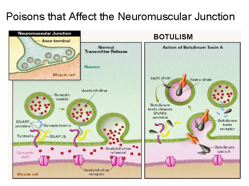 Poisons that Affect the Neuromuscular Junction BOTULISM 