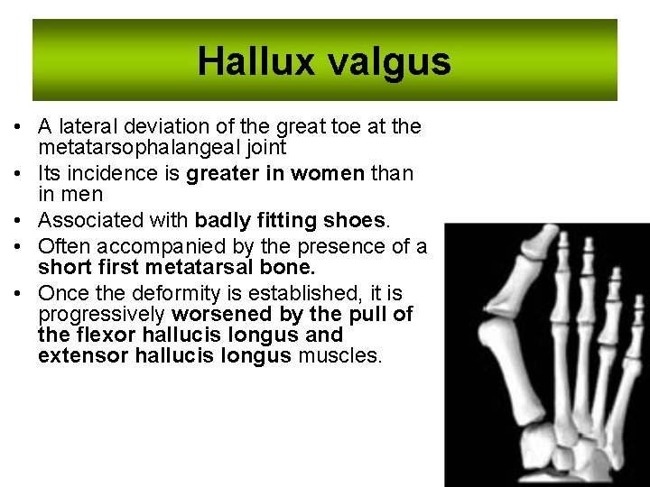 Hallux valgus • A lateral deviation of the great toe at the metatarsophalangeal joint