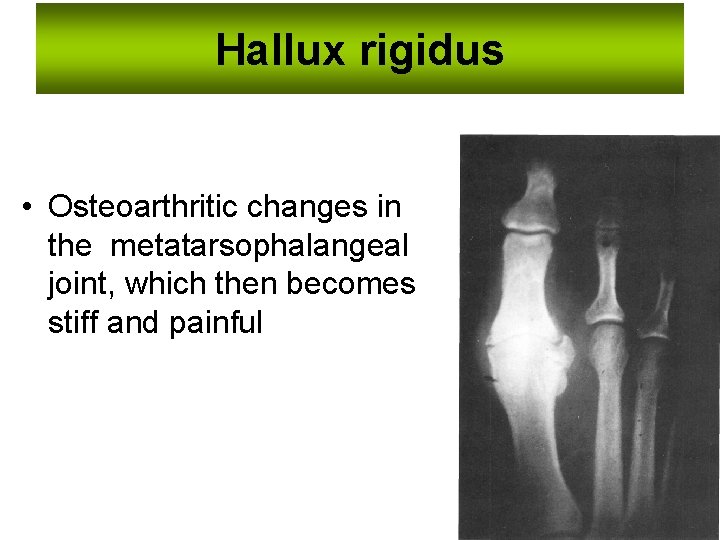 Hallux rigidus • Osteoarthritic changes in the metatarsophalangeal joint, which then becomes stiff and