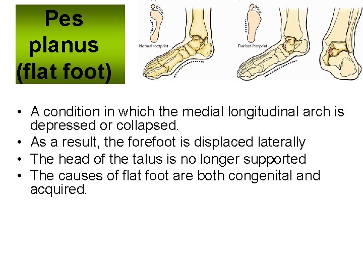 Pes planus (flat foot) • A condition in which the medial longitudinal arch is