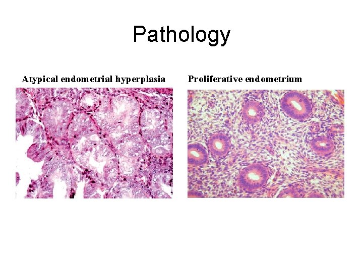 Pathology Atypical endometrial hyperplasia Proliferative endometrium 