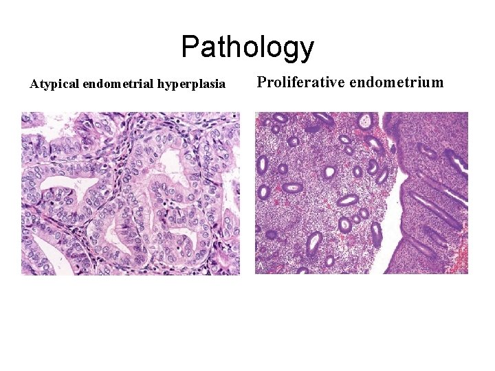 Pathology Atypical endometrial hyperplasia Proliferative endometrium 