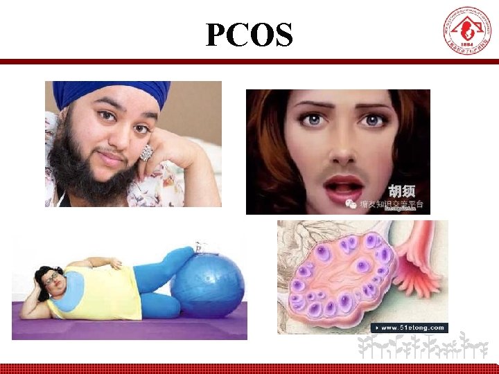 PCOS 