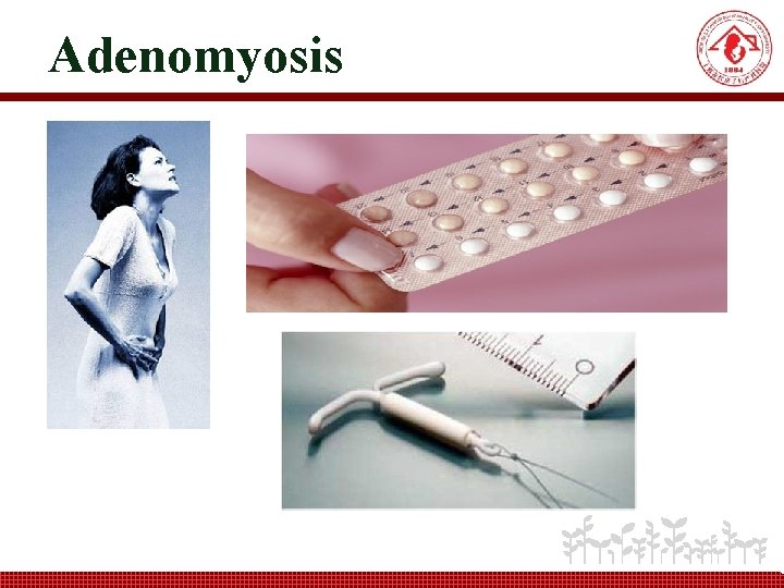 Adenomyosis 