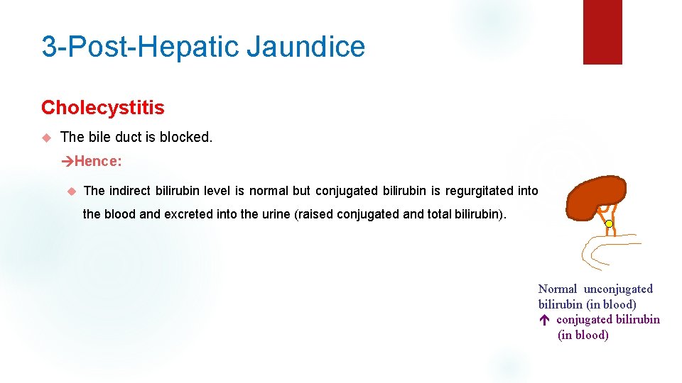 3 -Post-Hepatic Jaundice Cholecystitis The bile duct is blocked. Hence: The indirect bilirubin level