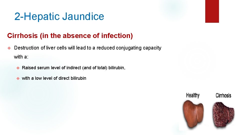 2 -Hepatic Jaundice Cirrhosis (in the absence of infection) Destruction of liver cells will