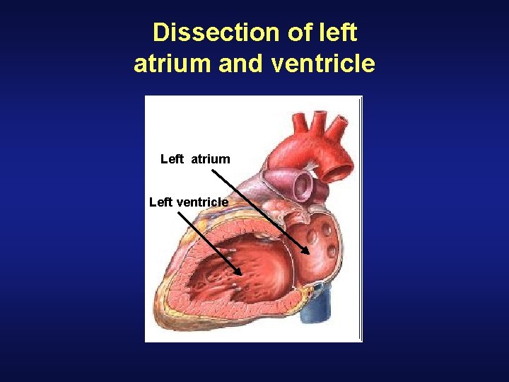 Dissection of left atrium and ventricle Left atrium Left ventricle Dissection of left atrium and ventricle Left atrium Left ventricle