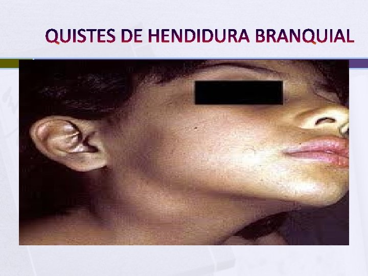 QUISTES DE HENDIDURA BRANQUIAL 