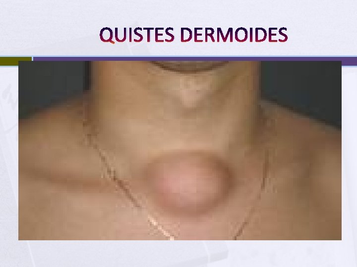 QUISTES DERMOIDES 