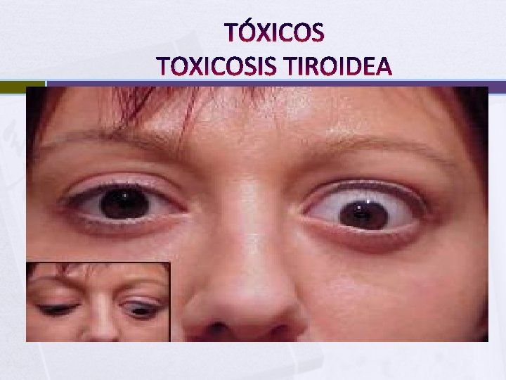 TÓXICOS TOXICOSIS TIROIDEA 