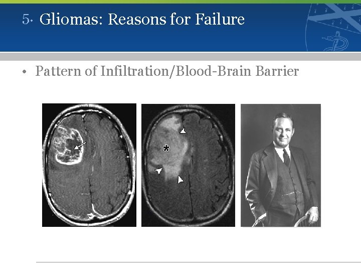 5. Gliomas: Reasons for Failure • Pattern of Infiltration/Blood-Brain Barrier 