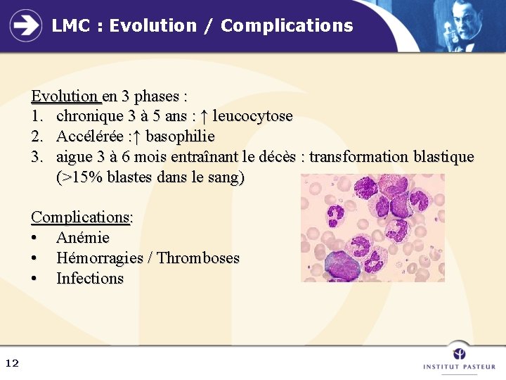 LMC : Evolution / Complications Evolution en 3 phases : 1. chronique 3 à