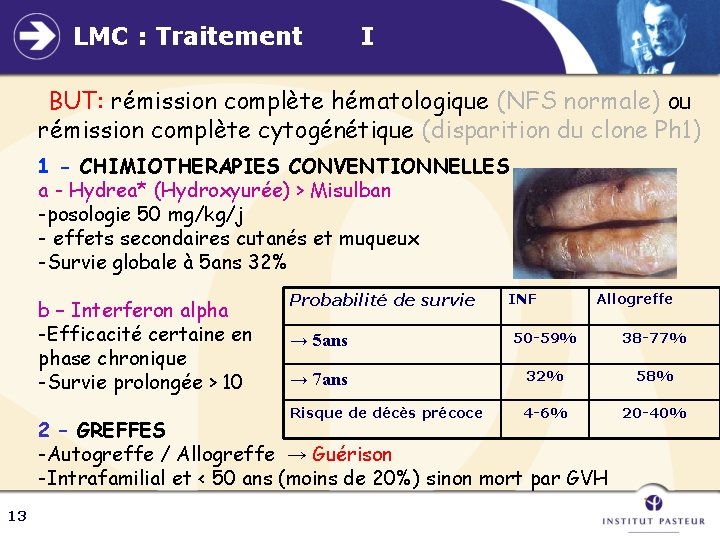 LMC : Traitement I BUT: rémission complète hématologique (NFS normale) ou rémission complète cytogénétique
