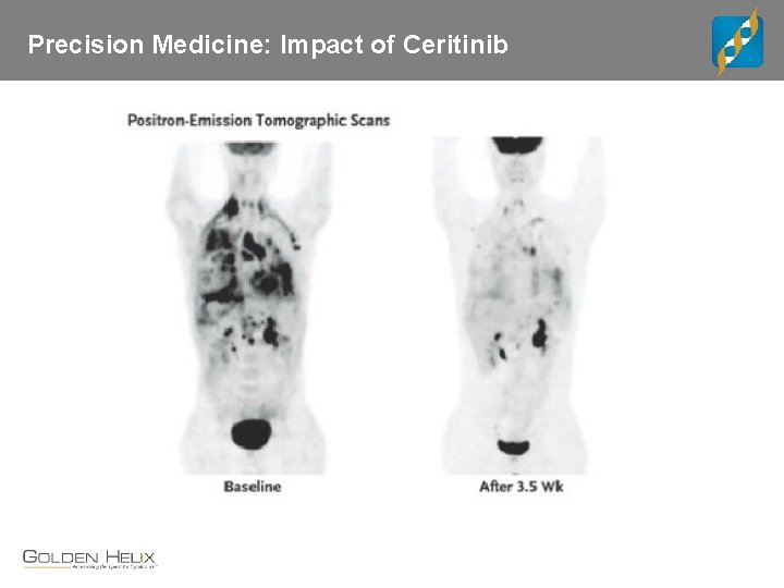 Precision Medicine: Impact of Ceritinib 