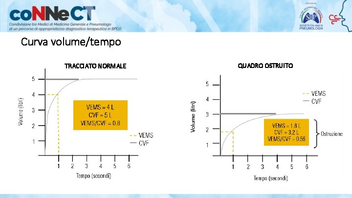 Curva volume/tempo TRACCIATO NORMALE QUADRO OSTRUITO 