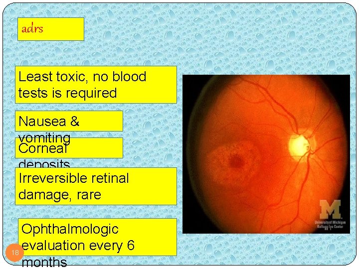 adrs Least toxic, no blood tests is required Nausea & vomiting Corneal deposits Irreversible