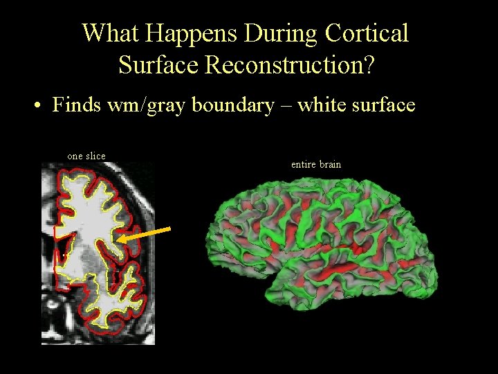 What Happens During Cortical Surface Reconstruction? • Finds wm/gray boundary – white surface one