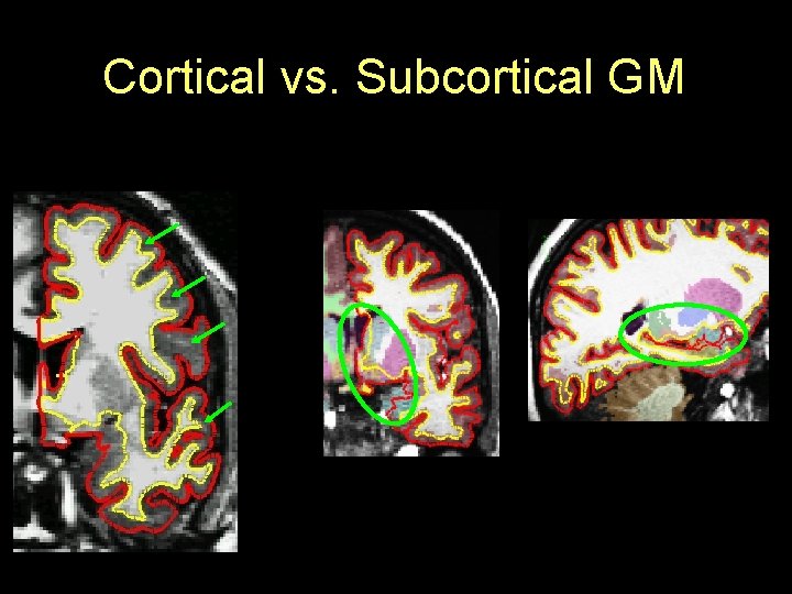 Cortical vs. Subcortical GM cortical gm subcortical gm sagittal coronal 