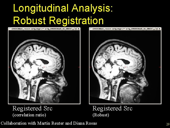 Longitudinal Analysis: Robust Registration Registered Src (correlation ratio) (Robust) Collaboration with Martin Reuter and