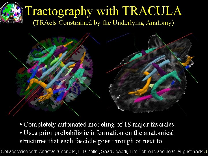 Tractography with TRACULA (TRActs Constrained by the Underlying Anatomy) • Completely automated modeling of