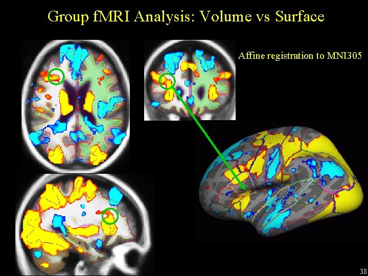 Group f. MRI Analysis: Volume vs Surface Affine registration to MNI 305 38 