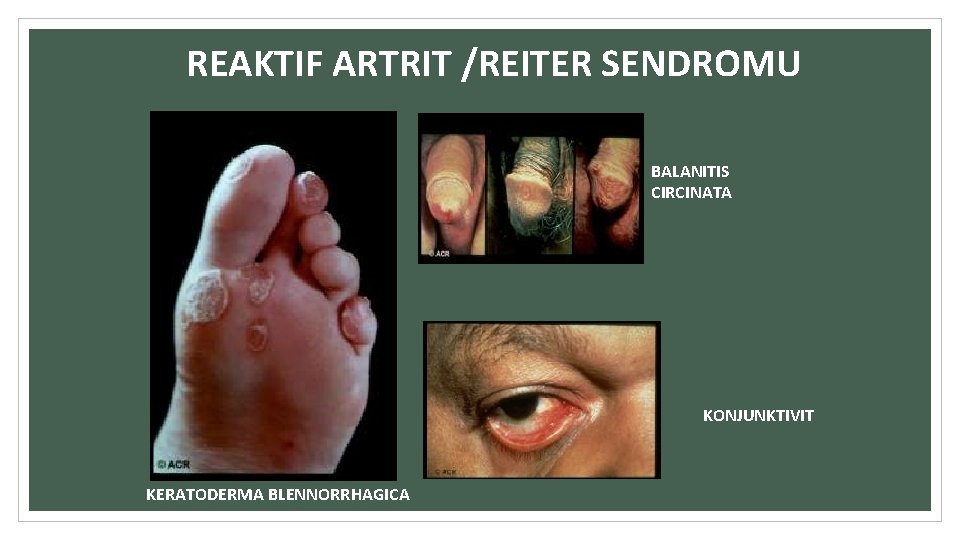 REAKTIF ARTRIT /REITER SENDROMU BALANITIS CIRCINATA KONJUNKTIVIT KERATODERMA BLENNORRHAGICA 