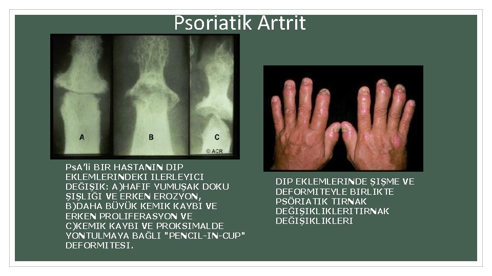 Psoriatik Artrit Ps. A’li BIR HASTANIN DIP EKLEMLERINDEKI ILERLEYICI DEĞIŞIK: A)HAFIF YUMUŞAK DOKU ŞIŞLIĞI