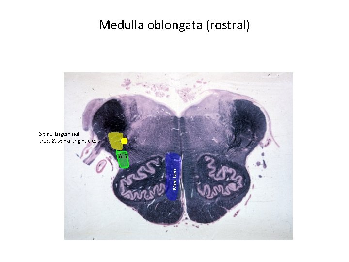 Medulla oblongata (rostral) Spinal trigeminal tract & spinal trig nucleus Med lem ALS 