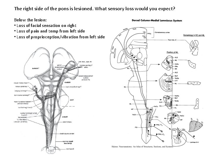 The right side of the pons is lesioned. What sensory loss would you expect?