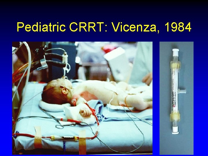 Pediatric CRRT: Vicenza, 1984 Pediatric CRRT: Vicenza, 1984
