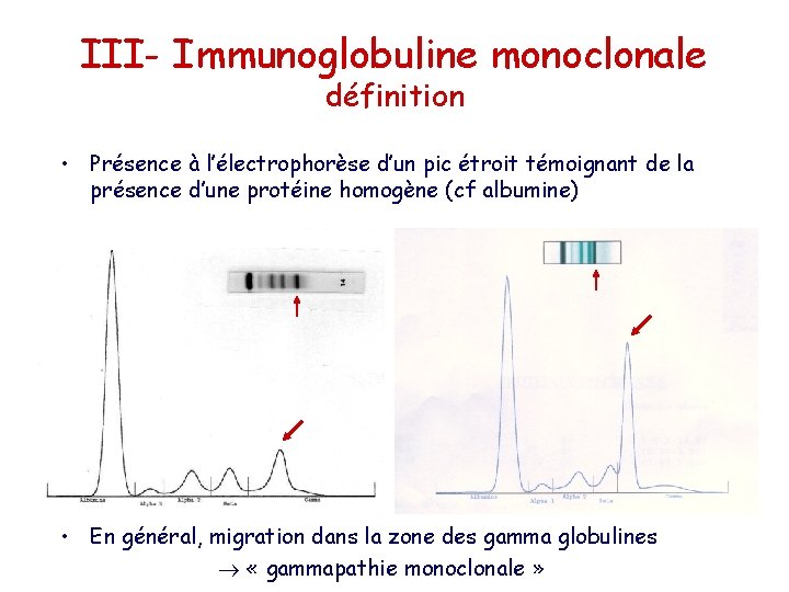 III- Immunoglobuline monoclonale définition • Présence à l’électrophorèse d’un pic étroit témoignant de la