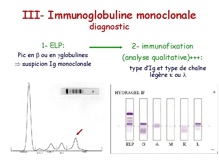 III- Immunoglobuline monoclonale diagnostic 1 - ELP: Pic en ou en globulines suspicion Ig