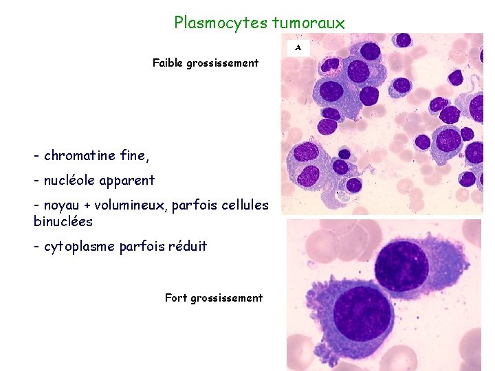 Plasmocytes tumoraux Faible grossissement - chromatine fine, - nucléole apparent - noyau + volumineux,