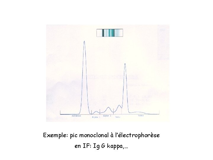 Exemple: pic monoclonal à l’électrophorèse en IF: Ig G kappa, … 