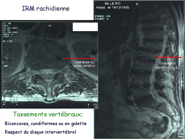 IRM rachidienne Tassements vertébraux: Biconcaves, cunéiformes ou en galette Respect du disque intervertébral 