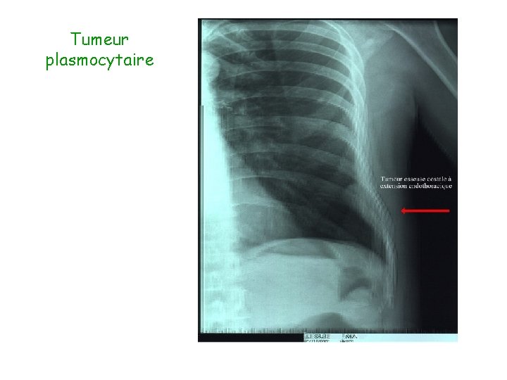 Tumeur plasmocytaire 