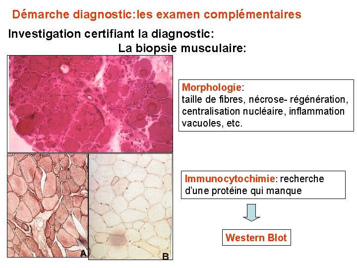 Démarche diagnostic: les examen complémentaires Investigation certifiant la diagnostic: La biopsie musculaire: Morphologie: taille