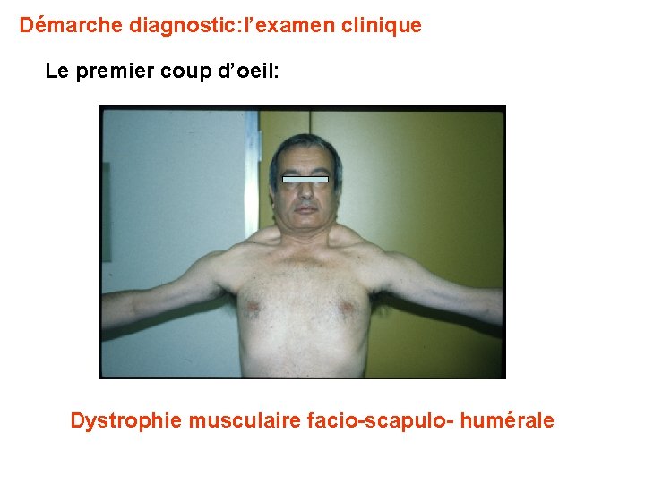 Démarche diagnostic: l’examen clinique Le premier coup d’oeil: Dystrophie musculaire facio-scapulo- humérale 